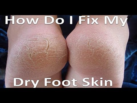 Dry, Itchy & Cracked Foot Skin [Home Treatment & Best Remedies!]