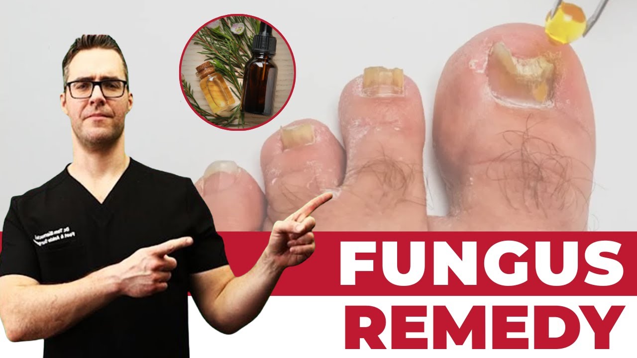 Tea Tree Oil Toenail Fungus Home Treatment [Doctor Cure!]