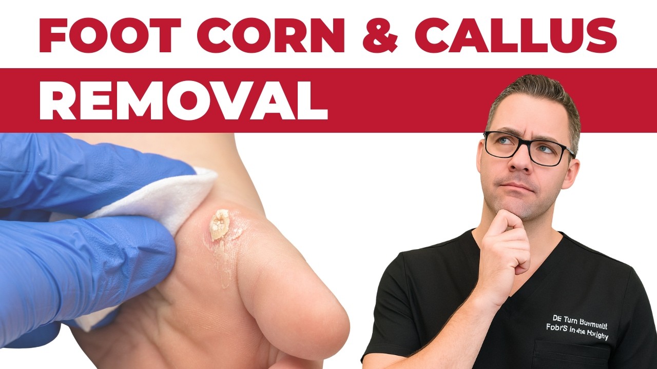 How To Remove a Foot Corn or Callus [Foot Doctor Home Treatment]