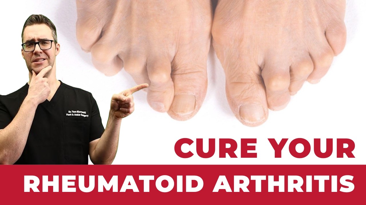 Rheumatoid Arthritis [Symptoms, Early Signs, Stages & BEST Treatment]
