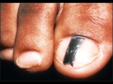 Are Black Toenail Lines & Streaks Safe? [Doctor Treatment]