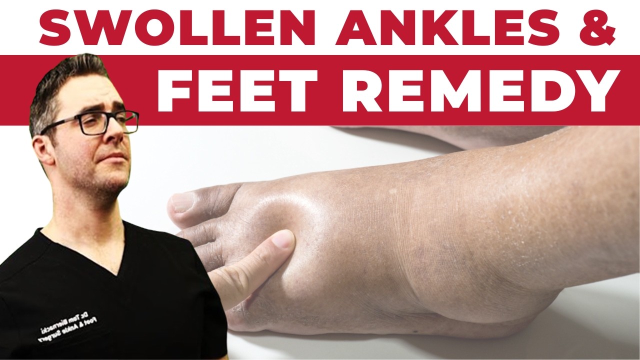 STOP Swollen Ankles & Swollen Feet [Treatment SECRETS 2024]!