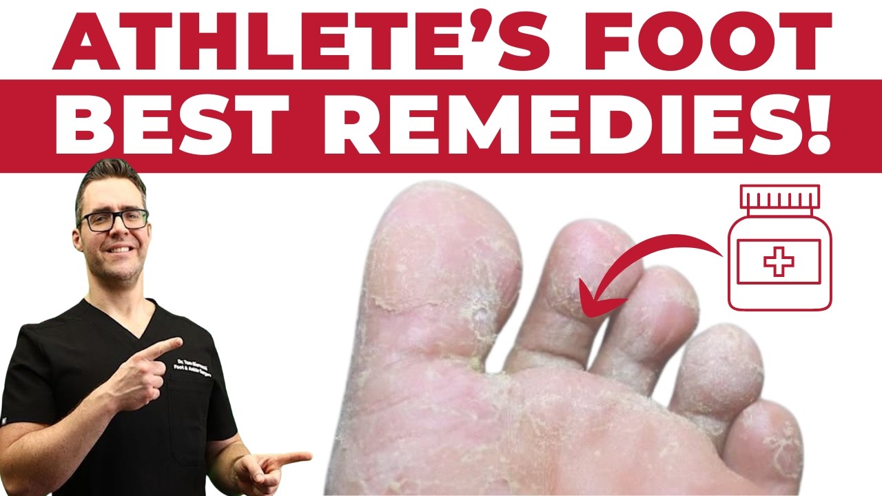Athlete's Foot Fungus [BEST Home Remedies & Treatment]