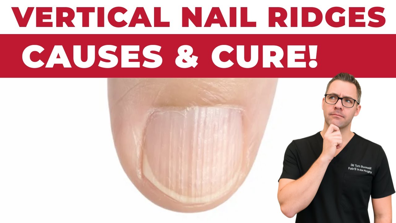 🖐Do you have Vertical Nail Ridges?  [Causes & Treatment]🖐