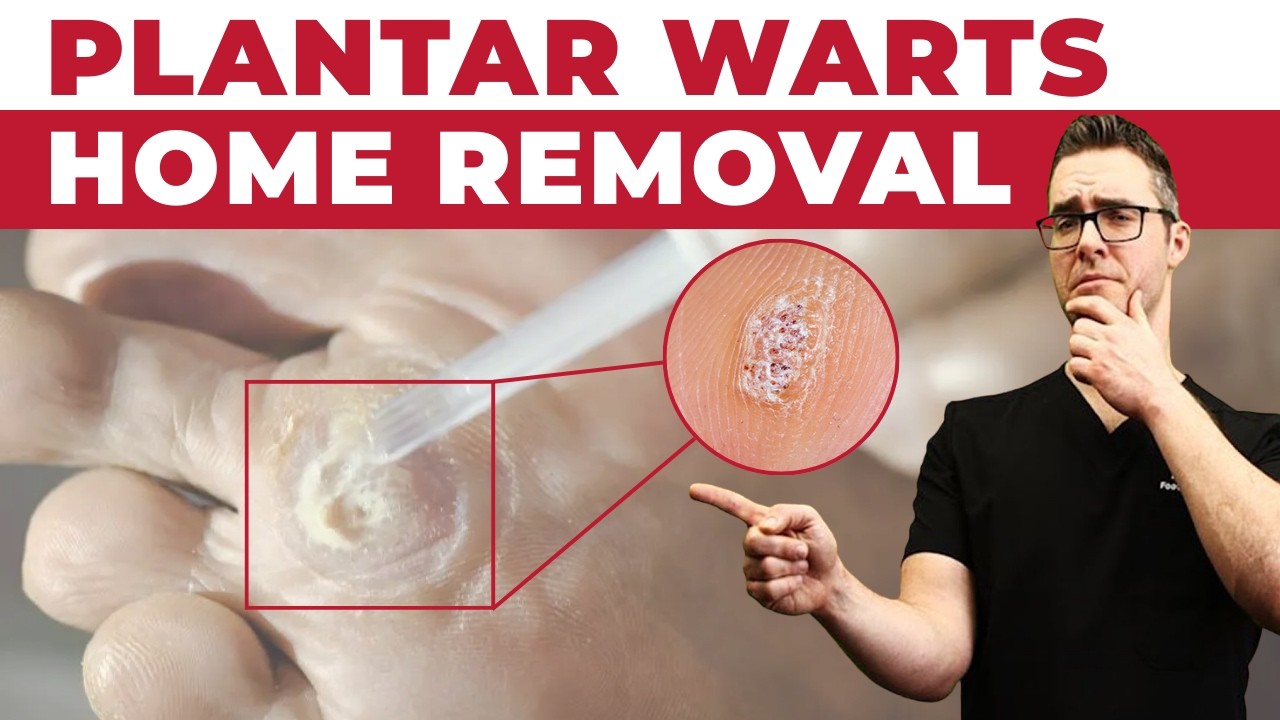 Plantar Warts On Feet And Toes [BEST HOME TREATMENTS]