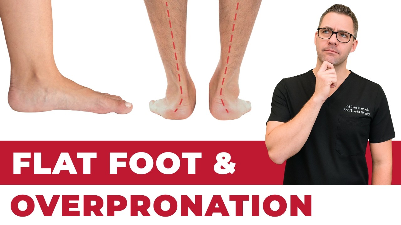 Flat Foot Reconstruction: Who Actually Needs Surgery