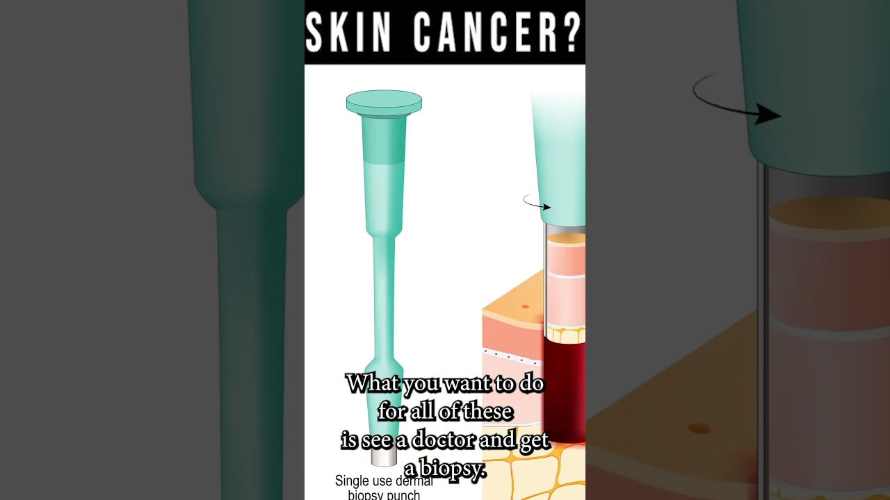 Skin Cancer Warning Signs — Dr. Tom Biernacki DPM