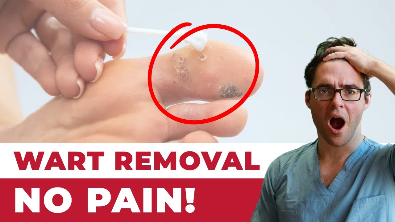 Plantar Wart Removal: How to Get Rid of a Foot Wart with No PAIN!